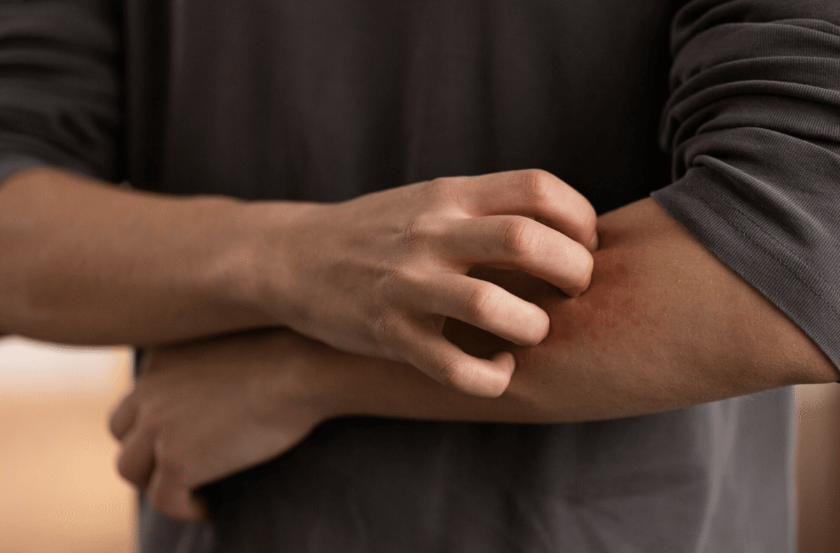 Dieta przy atopowym zapaleniu skóry (AZS) – co jeść, a czego unikać?