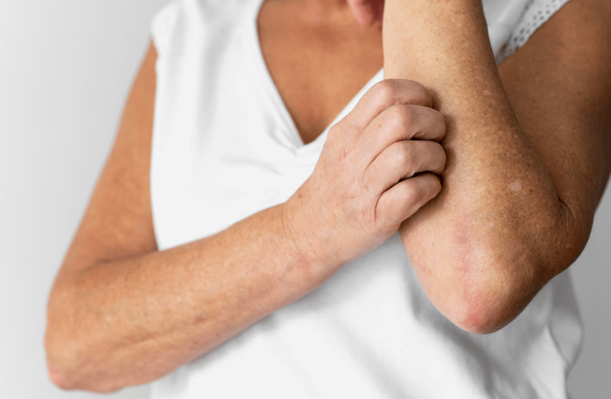 Dieta kontra AZS: jak probiotyki i omega-3 łagodzą objawy atopowego zapalenia skóry